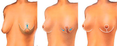 cost breast reduction tunisia